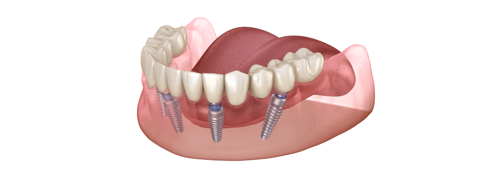 8 Facts About Dental Implants 8 Facts About Dental Implants