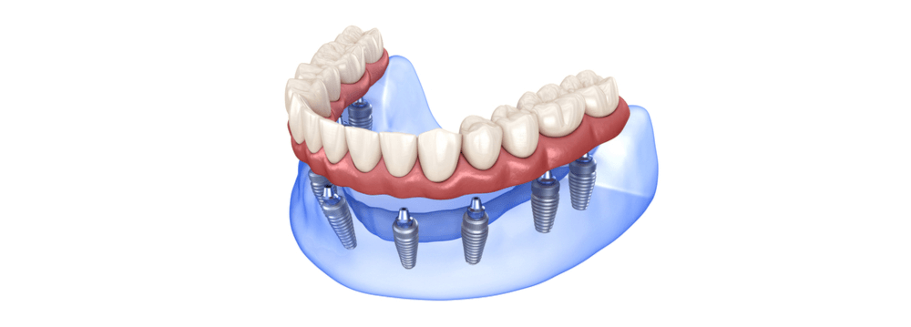 Decoding the Decision-Making: All-On-4 vs. All-On-6 Dental Implants