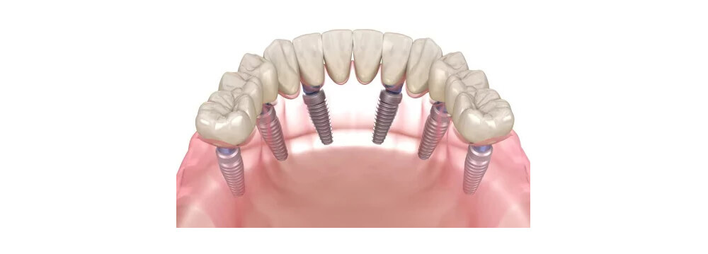 All-On-6 Treatment