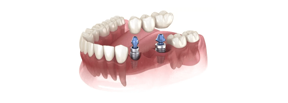 The Power of Local Anesthesia in Dental Implant Procedures