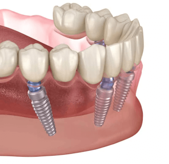 Dental Implants