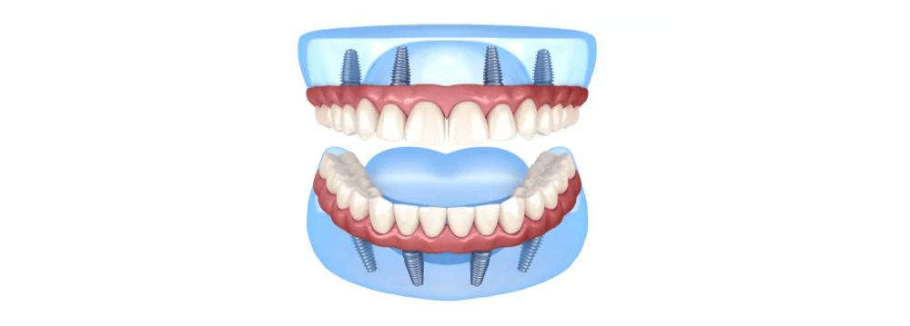 Removable Denture or Dental Implants?