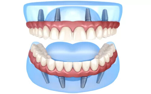 Full Mouth Restoration