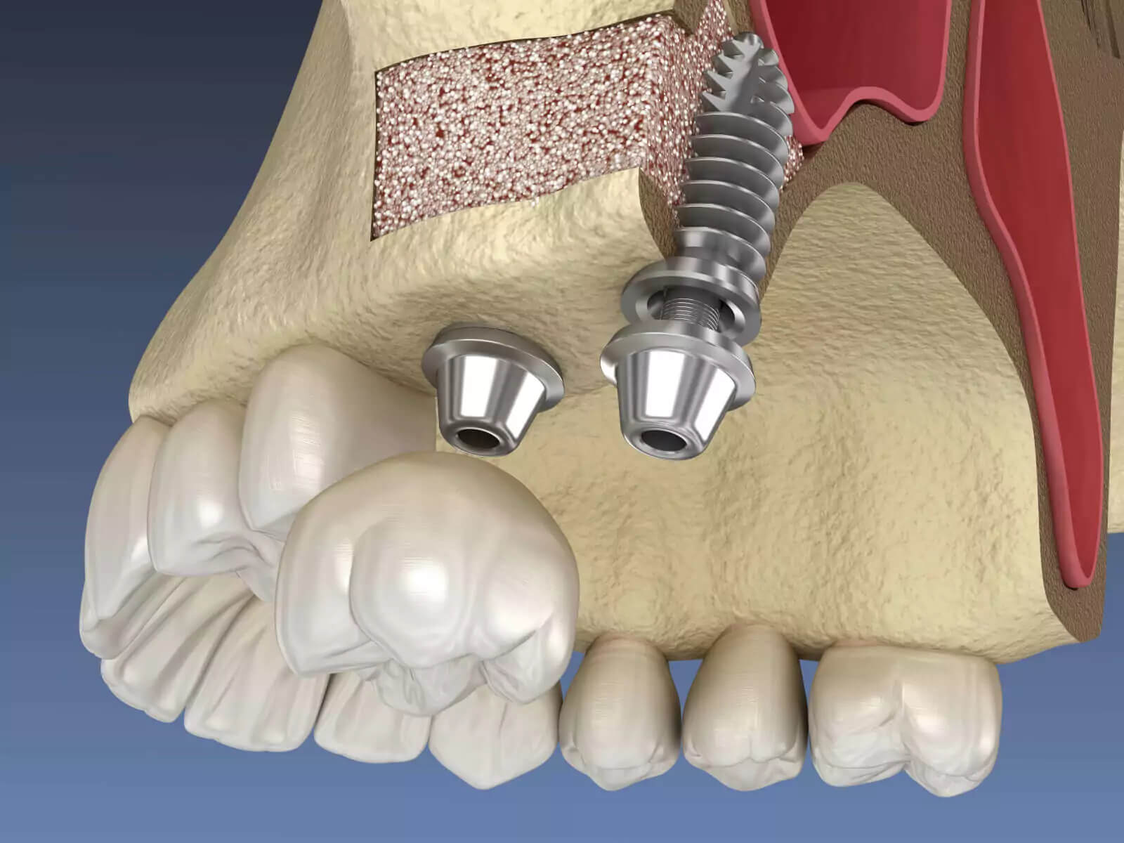 Jawbone Deterioration