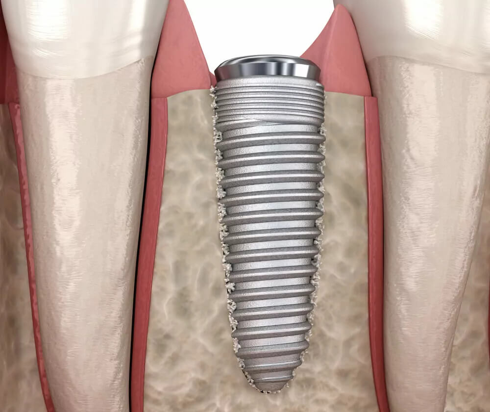 Osseointegration