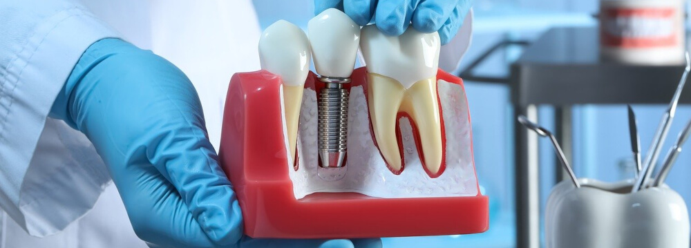 Missing Teeth and Poor Dental Health: The Broader Impact on Overall Well-being
