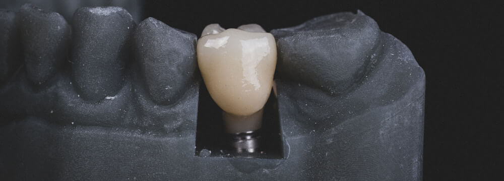 Understanding Edentulism: How Dental Implants Transform Oral Health